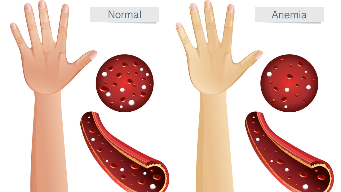 Anemia: sintomas, causas e tratamentos